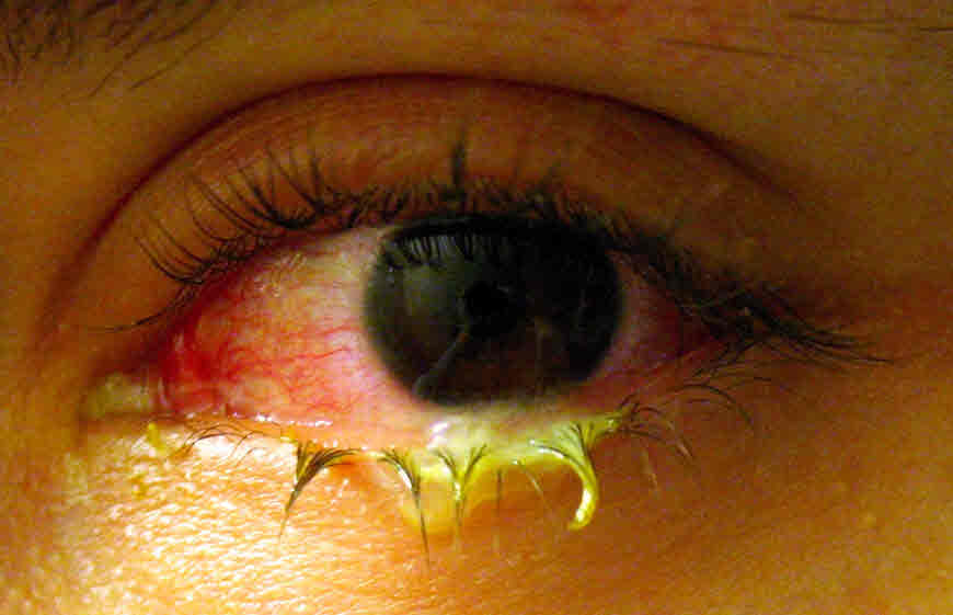 indian home remedies for conjunctivitis