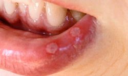 mouth ulcers