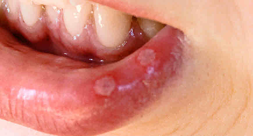 mouth ulcers