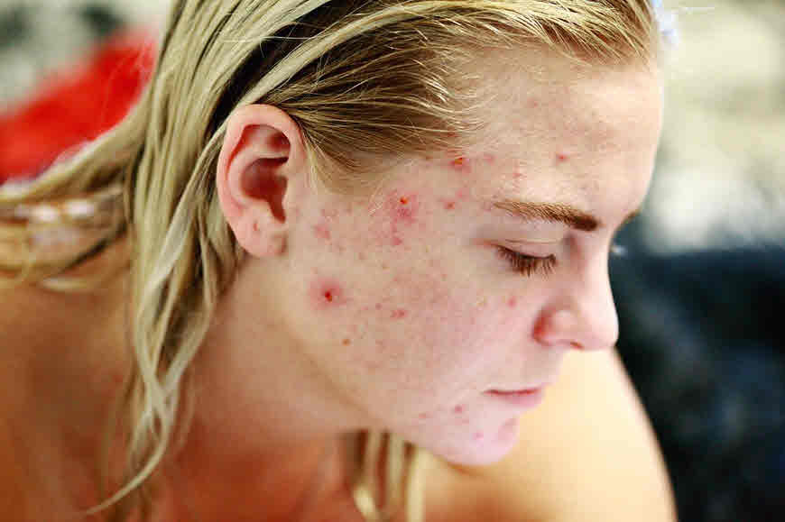 acne homeopathic medicines